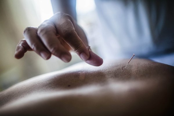 Les bienfaits de l'acupuncture pour traiter certains troubles de santé